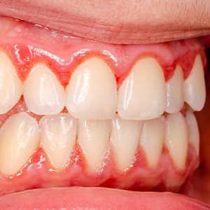 Red and inflamed gum tissue