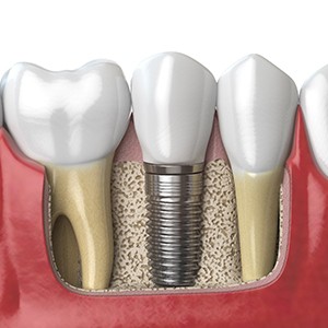 3D rendering of dental implants