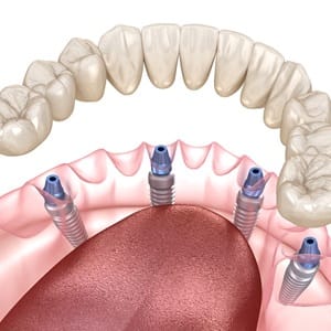 A digital image of a customized lower denture being secured over All-On-4 dental implants