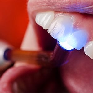 Closeup of smile during dental bonding