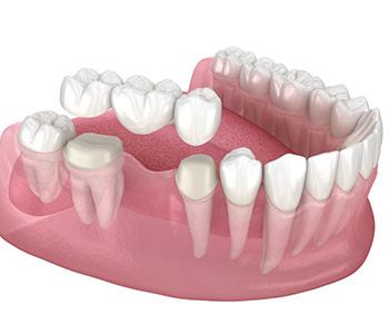 Illustration of traditional dental bridge against white background