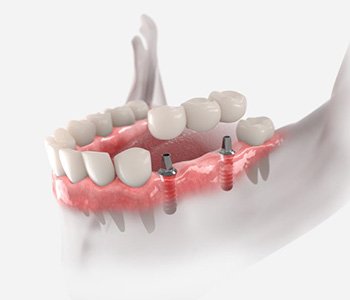 Illustration of dental implant bridge against white background