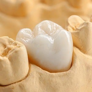 Dental crown on smile model