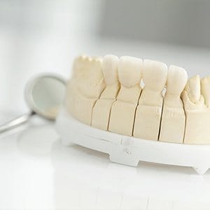 Fixed bridge on smile model