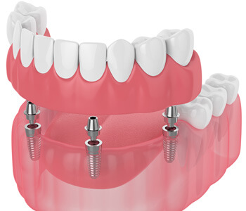 a 3D render of an implant denture