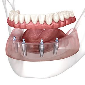 a woman getting her dentures checked by her dentist