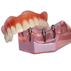 Implant dentures in North Naples