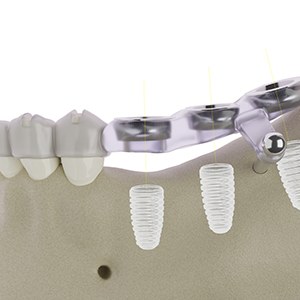 Illustration of guide used for dental implant surgery