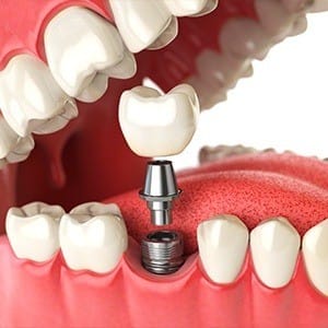 Animation of implant supported dental crown placement