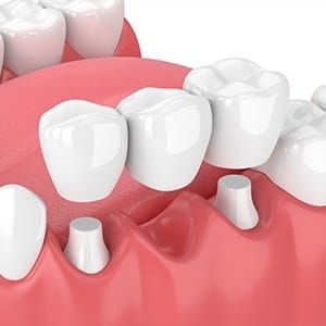 Animation of implant fixed bridge placement