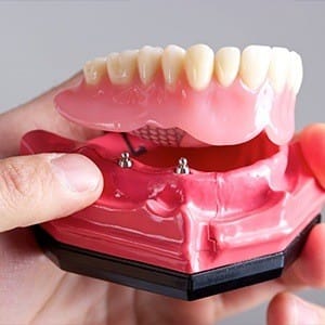 Model implant supported denture