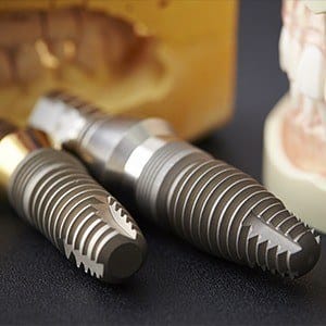 Dental implants and smile model
