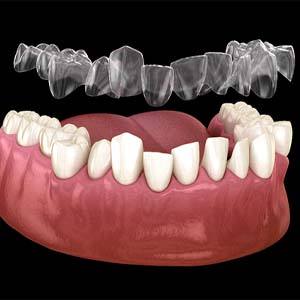 Crooked teeth with Invisalign in North Naples