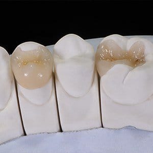 Model smile with inlay and onlay restorations