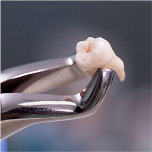 Metal clasp holding extracted tooth