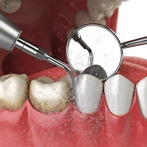 Animation of air abrasion treatment