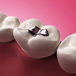 Animation of tooth with silver filling