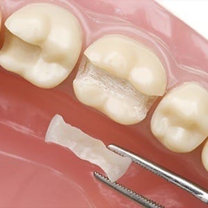 Model smile with inlay restoration