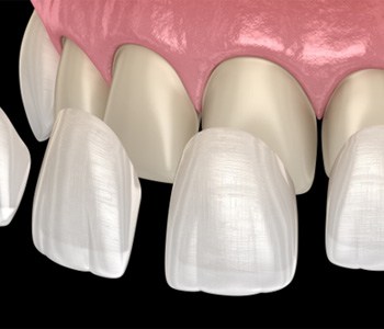 Illustration of veneers being placed on teeth