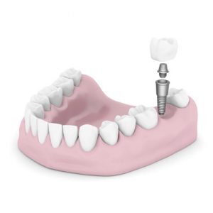 Dental implants can solve a missing tooth problem.