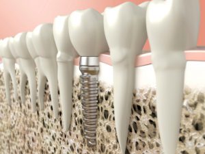 Have dental implants in North Naples when you want to replace missing teeth. 