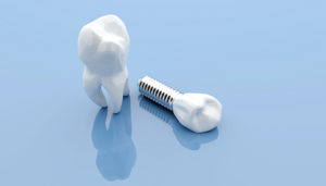 single dental implant against blue background