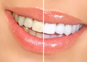 a before and after teeth whitening smile