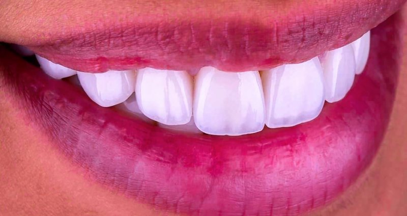 an up-close image of a woman’s smile that is exposing her top row of veneers