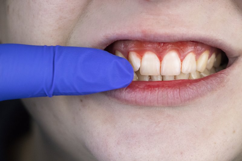 an up-close image of a gloved finger pointing to a person’s gums that appear red, swollen, and are bleeding